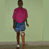 Gifted artificial limb weared beneficiary